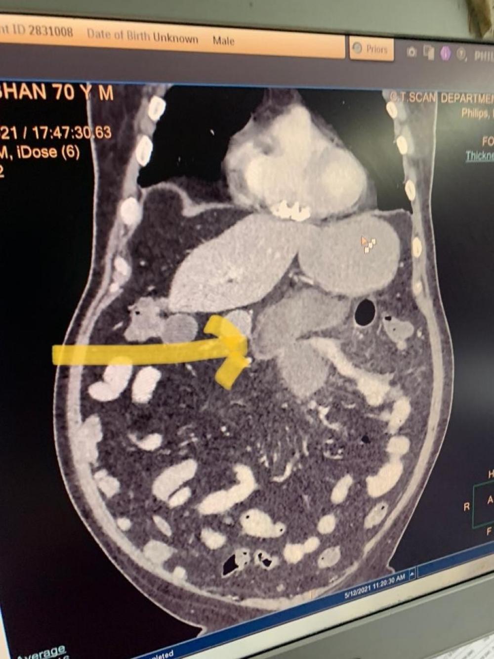 The Weekend Leader - Black fungus of intestine: Novel complication diagnosed in Covid patients in Delhi