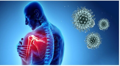 Is arthritis a major risk factor for Covid-19?